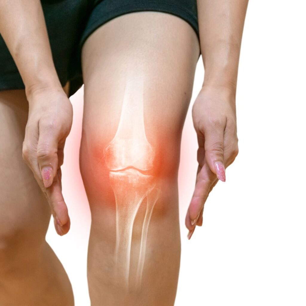 Woman placing her hands around her swollen knee. 